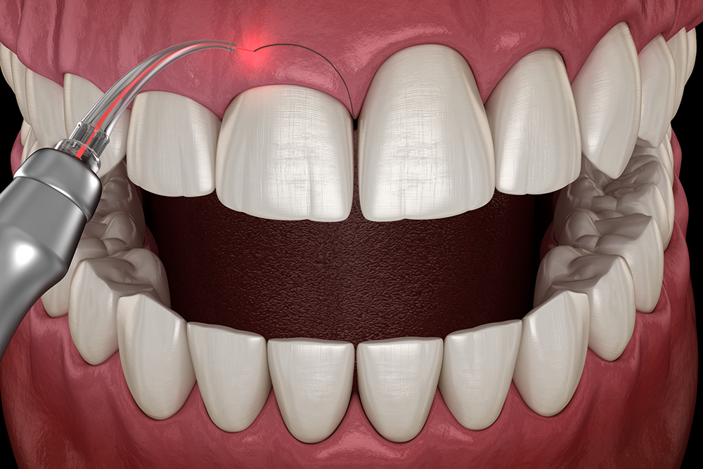 illustration of gum surgery