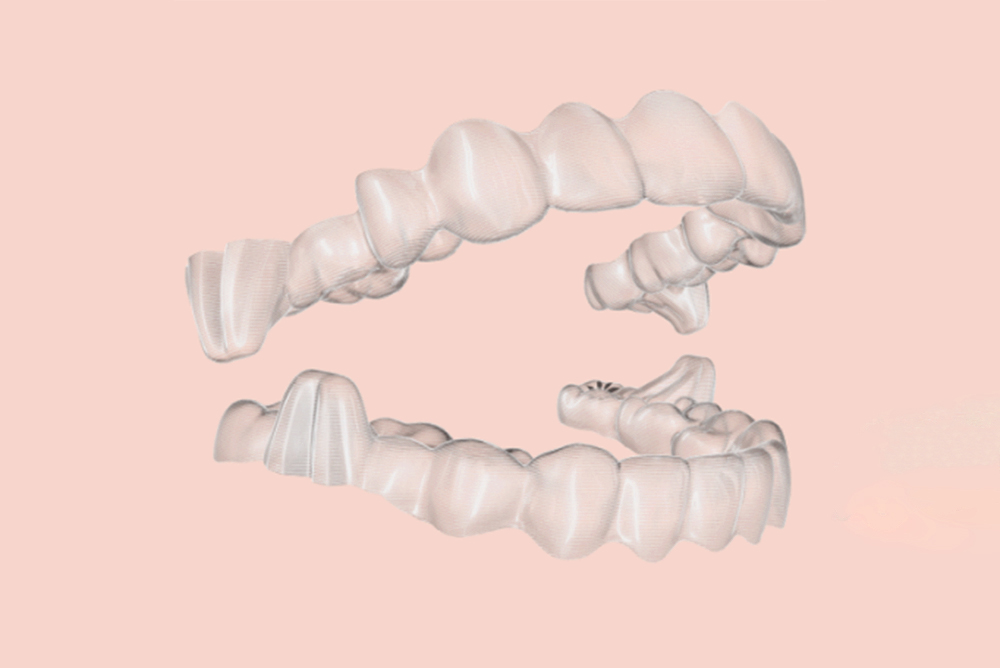 invisalign aligners with mandibular advancement protrusions