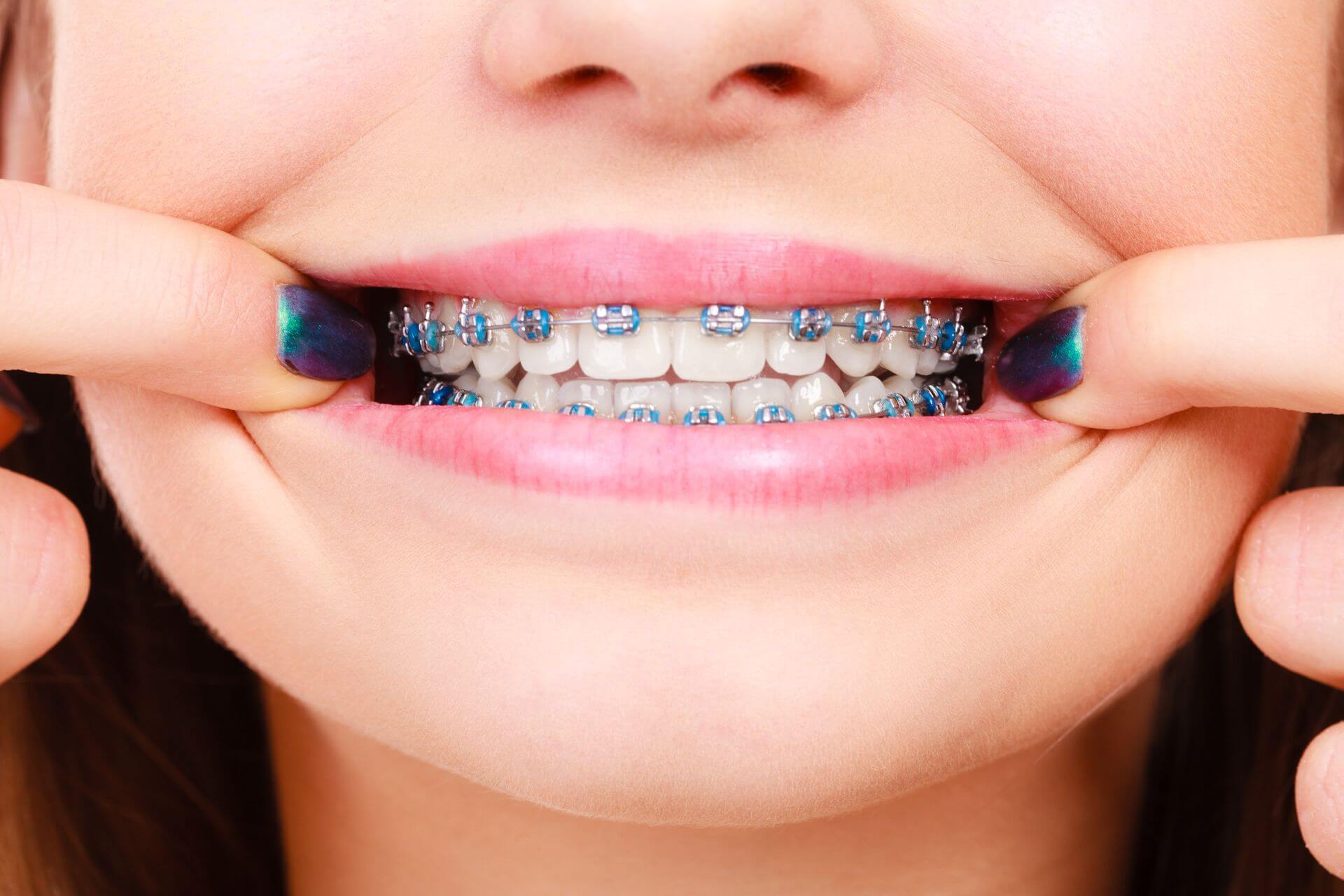 close-up smile with metal braces and blue bands