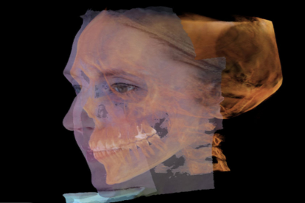 3d scan of face overlaid scan of skull