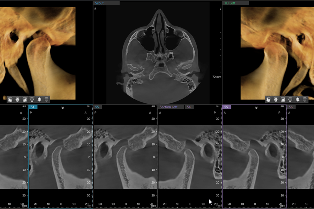 cbct scan showing various views of the skull and airway