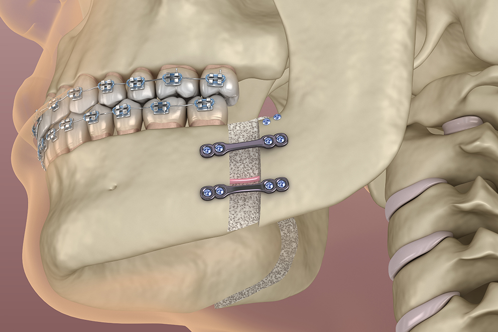 illustration of a jaw undergoing orthognathic surgery